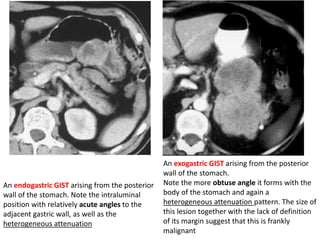 An endogastric GIST arising from the posterior 
wall of the stomach. Note the intraluminal 
position with relatively acute angles to the 
adjacent gastric wall, as well as the 
heterogeneous attenuation 
An exogastric GIST arising from the posterior 
wall of the stomach. 
Note the more obtuse angle it forms with the 
body of the stomach and again a 
heterogeneous attenuation pattern. The size of 
this lesion together with the lack of definition 
of its margin suggest that this is frankly 
malignant 
 