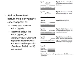 • At double-contrast 
barium meal early gastric 
cancer appears as: 
– an elevated polypoid 
lesion (type I), 
– superficial plaque-like 
lesion (type II), or 
– shallow irregular ulcer with 
adjacent nodular mucosa 
and associated amputation 
of radiating folds (type III) 
(Gold et al. 1984). 
 