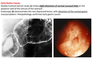 Early Gastric Cancer. 
Double Contrast barium study (a) shows slight distortion of normal mucosal folds on the 
posterior wall of the antrum of the stomach. 
Endoscopy (b) demonstrates the non-depressed lesion, with distortion of the normal gastric 
mucosal pattern. Histopathology confirmed early gastric cancer 
 