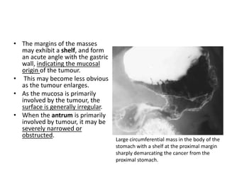 • The margins of the masses 
may exhibit a shelf, and form 
an acute angle with the gastric 
wall, indicating the mucosal 
origin of the tumour. 
• This may become less obvious 
as the tumour enlarges. 
• As the mucosa is primarily 
involved by the tumour, the 
surface is generally irregular. 
• When the antrum is primarily 
involved by tumour, it may be 
severely narrowed or 
obstructed. 
Large circumferential mass in the body of the 
stomach with a shelf at the proximal margin 
sharply demarcating the cancer from the 
proximal stomach. 
 