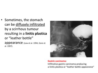 • Sometimes, the stomach 
can be diffusely infiltrated 
by a scirrhous tumour 
resulting in a linitis plastica 
or “leather bottle” 
appearance (Low et al. 1994; Gore et 
al. 1997). 
Gastric carcinoma: 
Infiltrative gastric carcinoma producing 
a linitis plastica or “leather bottle appearance” 
 