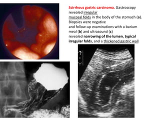 Scirrhous gastric carcinoma. Gastroscopy 
revealed irregular 
mucosal folds in the body of the stomach (a). 
Biopsies were negative 
and follow-up examinations with a barium 
meal (b) and ultrasound (c) 
revealed narrowing of the lumen, typical 
irregular folds, and a thickened gastric wall 
 