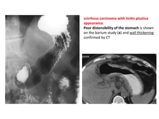 scirrhous carcinoma with linitis plastica 
appearance. 
Poor distensibility of the stomach is shown 
on the barium study (a) and wall thickening 
confirmed by CT 
 