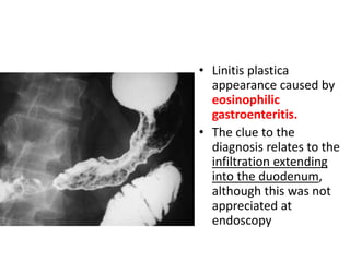 • Linitis plastica 
appearance caused by 
eosinophilic 
gastroenteritis. 
• The clue to the 
diagnosis relates to the 
infiltration extending 
into the duodenum, 
although this was not 
appreciated at 
endoscopy 
 