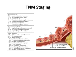 TNM Staging 
 