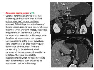 • Advanced gastric cancer (pT2). 
• Coronal reformation shows focal wall 
thickening of the antrum with marked 
enhancement of the mucosal layer 
(arrows). At histology, the outer layers of 
the muscularis propria were intact, whereas 
the inner layers were infi ltrated. The subtle 
irregularities of the mucosal surface 
correspond to ulceration at histology. Note 
the clear fat plane around the tumour. 
• Large carcinoma at the lesser curvature. 
Note that there is an area with irregular 
delineation of the tumour from the 
surrounding fat (arrowhead), which 
corresponds to a desmoplastic reaction at 
histology. There are two slightly 
hyperenhancing lymph nodes adjacent to 
each other (arrow); both proved to be 
metastases positive at histology. 
 
