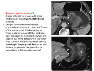 • Advanced gastric cancer (pT3). 
• A large polypoid carcinoma with gross 
infiltration of the perigastric fatty tissue 
(arrows). 
• Oblique coronal reformation tilted 
posteriorly to display the corpus and fundus 
of the stomach and distal oesophagus. 
There is a large tumour (T) that protrudes 
from the posterior wall into the lumen and 
appears as a filling defect within the water-filled 
stomach. Note the increased density 
stranding in the perigastric fat (arrow) and 
the oval lymph node that proved to be 
hyperplastic at histology (arrowhead) 
 