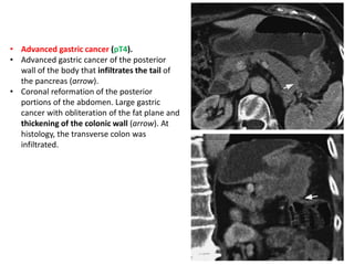 • Advanced gastric cancer (pT4). 
• Advanced gastric cancer of the posterior 
wall of the body that infiltrates the tail of 
the pancreas (arrow). 
• Coronal reformation of the posterior 
portions of the abdomen. Large gastric 
cancer with obliteration of the fat plane and 
thickening of the colonic wall (arrow). At 
histology, the transverse colon was 
infiltrated. 
 