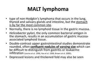 MALT lymphoma 
• type of non-Hodgkin's lymphoma that occurs in the lung, 
thyroid and salivary glands and intestine, but the stomach 
is by far the most common site. 
• Normally, there is no lymphoid tissue in the gastric mucosa. 
• Helicobacter pylori, the only common bacterial antigen in 
the stomach, results in an accumulation of gastric mucosa-associated 
lymphoid tissue. 
• Double-contrast upper gastrointestinal studies demonstrate 
rounded, often confluent nodules of varying size which can 
be difficult to distinguish from gastritis or leukaemic 
infiltration (Levine et al. 1996; Yoo et al. 1998; Brown et al. 2000). 
• Depressed lesions and thickened fold may also be seen 
 