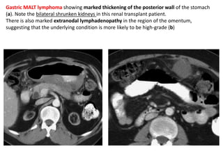 Gastric MALT lymphoma showing marked thickening of the posterior wall of the stomach 
(a). Note the bilateral shrunken kidneys in this renal transplant patient. 
There is also marked extranodal lymphadenopathy in the region of the omentum, 
suggesting that the underlying condition is more likely to be high-grade (b) 
 
