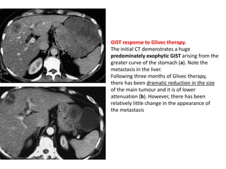 GIST response to Glivec therapy. 
The initial CT demonstrates a huge 
predominately exophytic GIST arising from the 
greater curve of the stomach (a). Note the 
metastasis in the liver. 
Following three months of Glivec therapy, 
there has been dramatic reduction in the size 
of the main tumour and it is of lower 
attenuation (b). However, there has been 
relatively little change in the appearance of 
the metastasis 
 