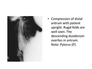 • Compression of distal 
antrum with patient 
upright. Rugal folds are 
well seen. The 
descending duodenum 
overlies in antrum. 
Note: Pylorus (P). 
 