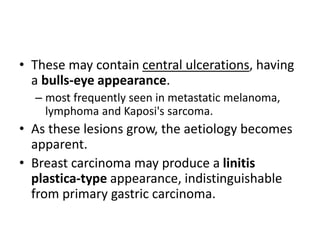 • These may contain central ulcerations, having 
a bulls-eye appearance. 
– most frequently seen in metastatic melanoma, 
lymphoma and Kaposi's sarcoma. 
• As these lesions grow, the aetiology becomes 
apparent. 
• Breast carcinoma may produce a linitis 
plastica-type appearance, indistinguishable 
from primary gastric carcinoma. 
 