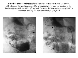 c Injection of air and contrast shows a possible further stricture in D2 (arrow). 
d The hydrophilic wire is exchanged for a heavy duty wire, note the junction of the 
flexible wire tip with the stiff shaft (arrow). The stent delivery system (arrowheads) is 
positioned, allowing for stent shortening deployment. 
 