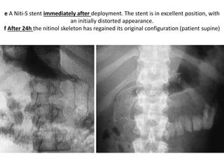 e A Niti-S stent immediately after deployment. The stent is in excellent position, with 
an initially distorted appearance. 
f After 24h the nitinol skeleton has regained its original configuration (patient supine) 
 