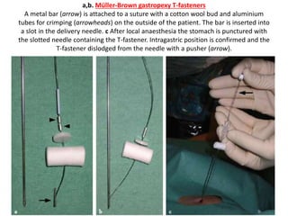 a,b. Müller-Brown gastropexy T-fasteners 
A metal bar (arrow) is attached to a suture with a cotton wool bud and aluminium 
tubes for crimping (arrowheads) on the outside of the patient. The bar is inserted into 
a slot in the delivery needle. c After local anaesthesia the stomach is punctured with 
the slotted needle containing the T-fastener. Intragastric position is confirmed and the 
T-fastener dislodged from the needle with a pusher (arrow). 
 