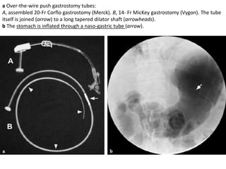 a Over-the-wire push gastrostomy tubes: 
A, assembled 20-Fr Corflo gastrostomy (Merck). B, 14- Fr MicKey gastrostomy (Vygon). The tube 
itself is joined (arrow) to a long tapered dilator shaft (arrowheads). 
b The stomach is inflated through a naso-gastric tube (arrow). 
 