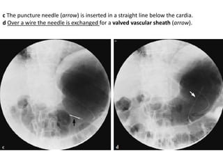 c The puncture needle (arrow) is inserted in a straight line below the cardia. 
d Over a wire the needle is exchanged for a valved vascular sheath (arrow). 
 