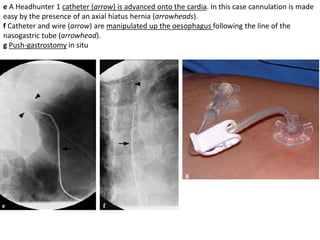e A Headhunter 1 catheter (arrow) is advanced onto the cardia. In this case cannulation is made 
easy by the presence of an axial hiatus hernia (arrowheads). 
f Catheter and wire (arrow) are manipulated up the oesophagus following the line of the 
nasogastric tube (arrowhead). 
g Push-gastrostomy in situ 
 