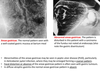 Areae gastricae. The normal pattern seen with 
a well-coated gastric mucosa at barium meal 
Abnormal areae gastricae. The pattern is 
disturbed in this patient with a carcinoma 
of the fundus not noted at endoscopy (also 
note the gastric diverticulum) 
• Abnormalities of the areae gastricae may be seen in peptic ulcer disease (PUD), particularly 
in Helicobacter pylori infection, where they may be enlarged forming a coarser pattern. 
• Focal distortion or absence of the areae gastricae pattern is often seen with gastric tumours. 
• In diffuse atrophic gastritis the normal areae gastricae pattern is absent. 
 