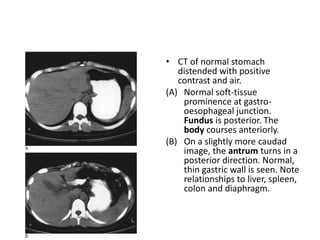 • CT of normal stomach 
distended with positive 
contrast and air. 
(A) Normal soft-tissue 
prominence at gastro-oesophageal 
junction. 
Fundus is posterior. The 
body courses anteriorly. 
(B) On a slightly more caudad 
image, the antrum turns in a 
posterior direction. Normal, 
thin gastric wall is seen. Note 
relationships to liver, spleen, 
colon and diaphragm. 
 
