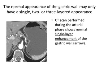 The normal appearance of the gastric wall may only 
have a single, two- or three-layered appearance 
• CT scan performed 
during the arterial 
phase shows normal 
single-layer 
enhancement of the 
gastric wall (arrow). 
 