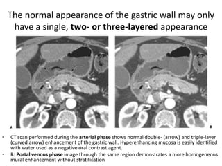 The normal appearance of the gastric wall may only 
have a single, two- or three-layered appearance 
• CT scan performed during the arterial phase shows normal double- (arrow) and triple-layer 
(curved arrow) enhancement of the gastric wall. Hyperenhancing mucosa is easily identified 
with water used as a negative oral contrast agent. 
• B: Portal venous phase image through the same region demonstrates a more homogeneous 
mural enhancement without stratification 
 