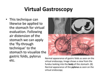Virtual Gastroscopy 
• This technique can 
likewise be applied to 
the stomach for virtual 
evaluation. Following 
air distension of the 
stomach we can apply 
the ‘fly-through 
technique’ to the 
stomach to visualize the 
gastric folds, pylorus 
etc. 
Normal appearance of gastric folds as seen on the 
virtual endoscopy. Image shows a view from the 
fundus looking into the body of the stomach. (B) 
Normal appearance of the pylorus as seen on the 
virtual endoscopy 
 