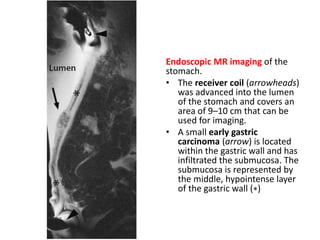 Endoscopic MR imaging of the 
stomach. 
• The receiver coil (arrowheads) 
was advanced into the lumen 
of the stomach and covers an 
area of 9–10 cm that can be 
used for imaging. 
• A small early gastric 
carcinoma (arrow) is located 
within the gastric wall and has 
infiltrated the submucosa. The 
submucosa is represented by 
the middle, hypointense layer 
of the gastric wall (∗) 
 