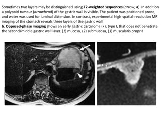 Sometimes two layers may be distinguished using T2-weighted sequences (arrow, a). In addition 
a polypoid tumour (arrowhead) of the gastric wall is visible. The patient was positioned prone, 
and water was used for luminal distension. In contrast, experimental high-spatial-resolution MR 
imaging of the stomach reveals three layers of the gastric wall 
b. Opposed-phase imaging shows an early gastric carcinoma (∗), type I, that does not penetrate 
the second/middle gastric wall layer. (1) mucosa, (2) submucosa, (3) muscularis propria 
 
