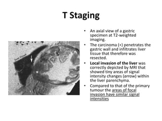 T Staging 
• An axial view of a gastric 
specimen at T2-weighted 
imaging. 
• The carcinoma (∗) penetrates the 
gastric wall and infiltrates liver 
tissue that therefore was 
resected. 
• Local invasion of the liver was 
correctly depicted by MRI that 
showed tiny areas of signal 
intensity changes (arrow) within 
the liver parenchyma. 
• Compared to that of the primary 
tumour the areas of focal 
invasion have similar signal 
intensities 
 