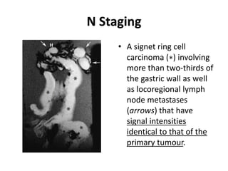 N Staging 
• A signet ring cell 
carcinoma (∗) involving 
more than two-thirds of 
the gastric wall as well 
as locoregional lymph 
node metastases 
(arrows) that have 
signal intensities 
identical to that of the 
primary tumour. 
 