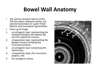 Bowel Wall Anatomy 
• The normal stomach wall at 12 Mz. 
The five layers, between arrows, are 
well demonstrated. b= water-fi lled 
balloon and associated ring-artefacts. 
• Close-up of image 
1. an echogenic layer representing the 
interface between the balloon (b) 
and the superficial mucosa, 
2. a hypoechoic layer representing the 
deeper mucosa including the 
muscularis propria, 
3. an echogenic layer comprising the 
submucosa, 
4. a hypoechoic layer, the muscularis 
propria, and 
5. the echogenic serosa 
 