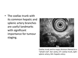 • The coeliac trunk with 
its common hepatic and 
splenic artery branches 
are useful landmarks 
with significant 
importance for tumour 
staging. 
Coeliac trunk and its major divisions likened to a 
“whale’s tail”. Ao= aorta, CT= coeliac trunk, SpA= 
splenic artery, HA= hepatic artery 
 
