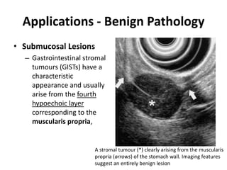 Applications - Benign Pathology 
• Submucosal Lesions 
– Gastrointestinal stromal 
tumours (GISTs) have a 
characteristic 
appearance and usually 
arise from the fourth 
hypoechoic layer 
corresponding to the 
muscularis propria, 
A stromal tumour (*) clearly arising from the muscularis 
propria (arrows) of the stomach wall. Imaging features 
suggest an entirely benign lesion 
 