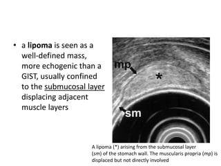 • a lipoma is seen as a 
well-defined mass, 
more echogenic than a 
GIST, usually confined 
to the submucosal layer 
displacing adjacent 
muscle layers 
A lipoma (*) arising from the submucosal layer 
(sm) of the stomach wall. The muscularis propria (mp) is 
displaced but not directly involved 
 