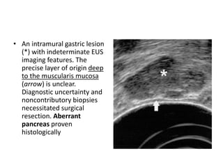 • An intramural gastric lesion 
(*) with indeterminate EUS 
imaging features. The 
precise layer of origin deep 
to the muscularis mucosa 
(arrow) is unclear. 
Diagnostic uncertainty and 
noncontributory biopsies 
necessitated surgical 
resection. Aberrant 
pancreas proven 
histologically 
 