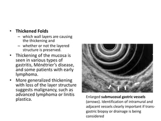 • Thickened Folds 
– which wall layers are causing 
the thickening and 
– whether or not the layered 
structure is preserved. 
• Thickening of the mucosa is 
seen in various types of 
gastritis, Ménétrier’s disease, 
and some patients with early 
lymphoma. 
• More generalized thickening 
with loss of the layer structure 
suggests malignancy, such as 
advanced lymphoma or linitis 
plastica. Enlarged submucosal gastric vessels 
(arrows). Identification of intramural and 
adjacent vessels clearly important if trans-gastric 
biopsy or drainage is being 
considered 
 