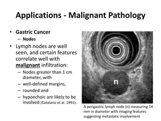 Applications - Malignant Pathology 
• Gastric Cancer 
– Nodes 
• Lymph nodes are well 
seen, and certain features 
correlate well with 
malignant infiltration: 
– Nodes greater than 1 cm 
diameter, with 
– well-defined margins, 
– rounded and 
– hypoechoic are likely to be 
involved (Catalano et al. 1991). 
A perigastric lymph node (n) measuring 14 
mm in diameter with imaging features 
suggesting metastatic involvement 
 