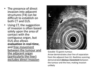• The presence of direct 
invasion into adjacent 
structures (T4) can be 
difficult to establish on 
both CT and EUS. 
• Using CT, the suggestion 
of invasion is often based 
solely upon the area of 
contact with the 
contiguous organ, but 
EUS also allows 
evaluation in real-time, 
and free movement 
between the tumour and 
the adjacent organ 
(particularly the liver) 
excludes direct invasion 
Sizeable T2 gastric tumour. 
Arrow demonstrates clear line of separation 
from the adjacent liver (L). Realtime scanning 
demonstrated obvious movement between 
the tumour and the liver, making invasion 
unlikely 
 