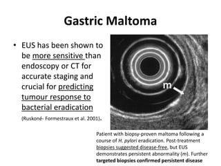 Gastric Maltoma 
• EUS has been shown to 
be more sensitive than 
endoscopy or CT for 
accurate staging and 
crucial for predicting 
tumour response to 
bacterial eradication 
(Ruskoné- Formestraux et al. 2001). 
Patient with biopsy-proven maltoma following a 
course of H. pylori eradication. Post-treatment 
biopsies suggested disease-free, but EUS 
demonstrates persistent abnormality (m). Further 
targeted biopsies confirmed persistent disease 
 