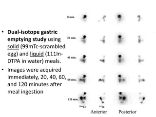 • Dual-isotope gastric 
emptying study using 
solid (99mTc-scrambled 
egg) and liquid (111In- 
DTPA in water) meals. 
• Images were acquired 
immediately, 20, 40, 60, 
and 120 minutes after 
meal ingestion 
 