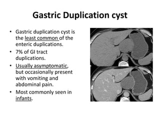Gastric Duplication cyst 
• Gastric duplication cyst is 
the least common of the 
enteric duplications. 
• 7% of GI tract 
duplications. 
• Usually asymptomatic, 
but occasionally present 
with vomiting and 
abdominal pain. 
• Most commonly seen in 
infants. 
 