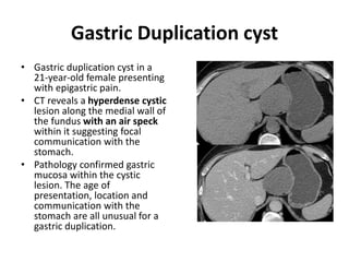 Gastric Duplication cyst 
• Gastric duplication cyst in a 
21-year-old female presenting 
with epigastric pain. 
• CT reveals a hyperdense cystic 
lesion along the medial wall of 
the fundus with an air speck 
within it suggesting focal 
communication with the 
stomach. 
• Pathology confirmed gastric 
mucosa within the cystic 
lesion. The age of 
presentation, location and 
communication with the 
stomach are all unusual for a 
gastric duplication. 
 