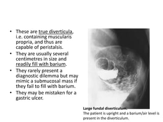 • These are true diverticula, 
i.e. containing muscularis 
propria, and thus are 
capable of peristalsis. 
• They are usually several 
centimetres in size and 
readily fill with barium. 
• They rarely present a 
diagnostic dilemma but may 
mimic a submucosal mass if 
they fail to fill with barium. 
• They may be mistaken for a 
gastric ulcer. 
Large fundal diverticulum. 
The patient is upright and a barium/air level is 
present in the diverticulum. 
 
