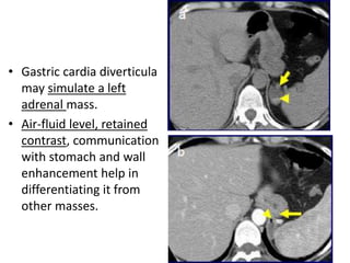 • Gastric cardia diverticula 
may simulate a left 
adrenal mass. 
• Air-fluid level, retained 
contrast, communication 
with stomach and wall 
enhancement help in 
differentiating it from 
other masses. 
 