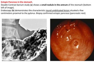Ectopic Pancreas in the stomach. 
Double Contrast barium study (a) shows a small nodule in the antrum of the stomach (bottom 
left of image). 
Endoscopy (b) demonstrates the characteristic round umbilicated lesion situated a few 
centimeters proximal to the pylorus. Biopsy confirmed ectopic pancreas (pancreatic rest) 
 