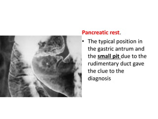 Pancreatic rest. 
• The typical position in 
the gastric antrum and 
the small pit due to the 
rudimentary duct gave 
the clue to the 
diagnosis 
 