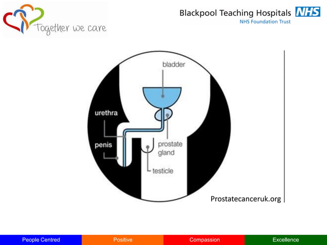 Prostate cancer Diagnosis and management | PPT