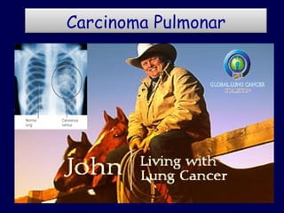 Carcinoma Pulmonar
 